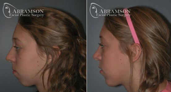 Ethnic Rhinoplasty result at Peter Jay Abramson, MD - Abramson Facial Plastic Surgery & Rejuvenation Center in Sandy Springs, GA