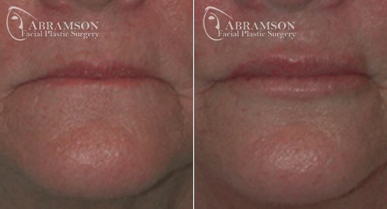 Peter Jay Abramson, MD - Abramson Facial Plastic Surgery & Rejuvenation Center lip filler result — Sandy Springs, GA