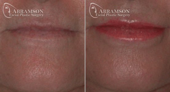 Peter Jay Abramson, MD - Abramson Facial Plastic Surgery & Rejuvenation Center lip filler result — Sandy Springs, GA