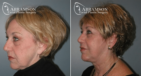Neck Lift result at Peter Jay Abramson, MD - Abramson Facial Plastic Surgery & Rejuvenation Center in Sandy Springs, GA