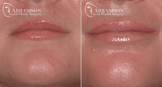 Peter Jay Abramson, MD - Abramson Facial Plastic Surgery & Rejuvenation Center lip filler result — Sandy Springs, GA