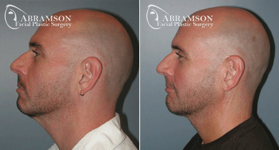 Facelift result at Peter Jay Abramson, MD - Abramson Facial Plastic Surgery & Rejuvenation Center in Sandy Springs, GA