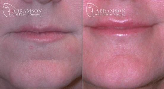 Peter Jay Abramson, MD - Abramson Facial Plastic Surgery & Rejuvenation Center lip filler result — Sandy Springs, GA