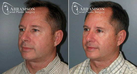 Blepharoplasty result at Peter Jay Abramson, MD - Abramson Facial Plastic Surgery & Rejuvenation Center in Sandy Springs, GA