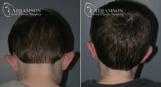 Peter Jay Abramson, MD - Abramson Facial Plastic Surgery & Rejuvenation Center otoplasty result — Sandy Springs, GA