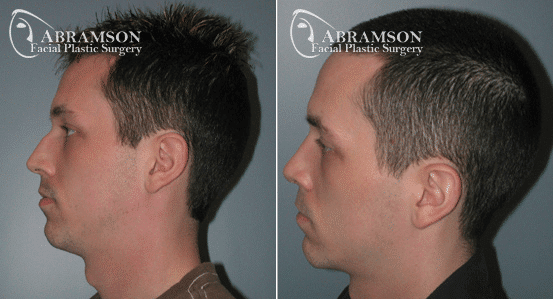 Ethnic Rhinoplasty result at Peter Jay Abramson, MD - Abramson Facial Plastic Surgery & Rejuvenation Center in Sandy Springs, GA