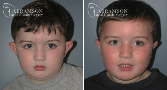 Peter Jay Abramson, MD - Abramson Facial Plastic Surgery & Rejuvenation Center otoplasty result — Sandy Springs, GA
