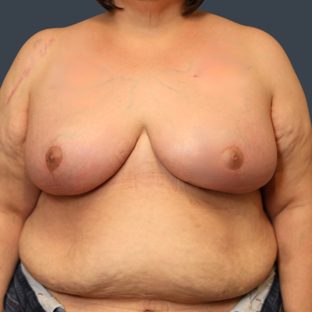 Breast Reduction after at Dr. Christine Fisher MD, FACS in Austin, TX