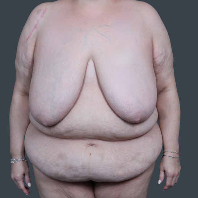 Breast Reduction before at Dr. Christine Fisher MD, FACS in Austin, TX