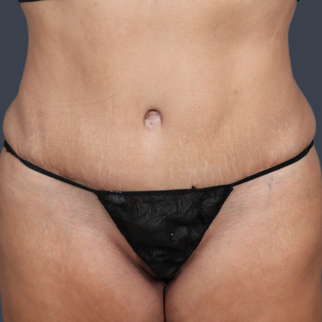 Tummy Tuck after at Dr. Christine Fisher MD, FACS in Austin, TX