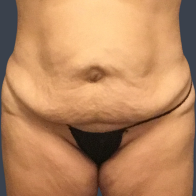 Tummy Tuck before at Dr. Christine Fisher MD, FACS in Austin, TX
