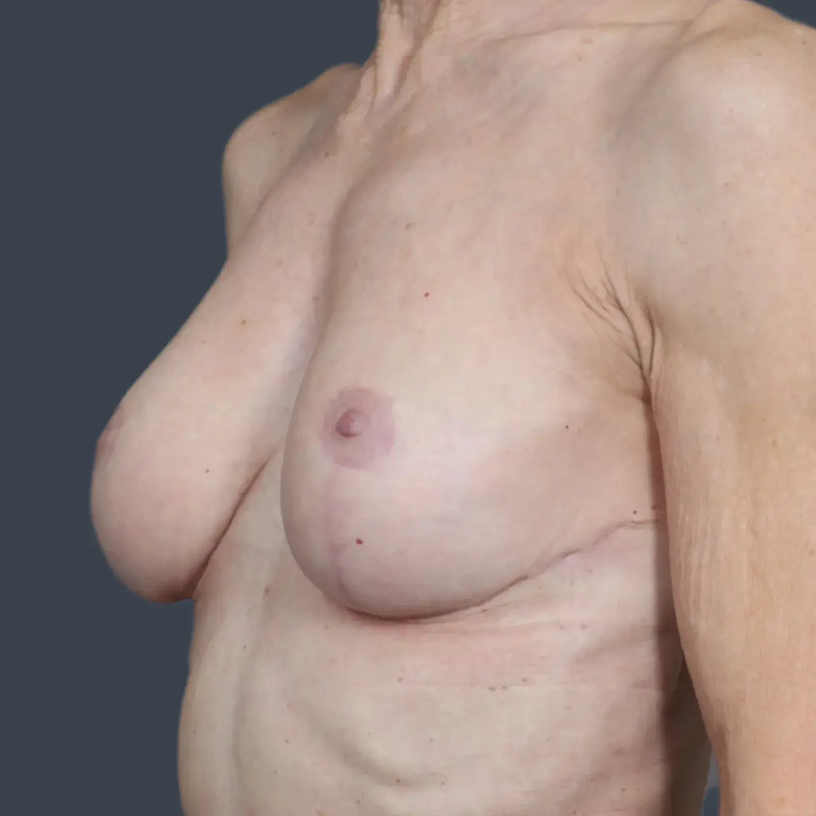 Dr. Christine Fisher MD, FACS breast lift after — Austin, TX