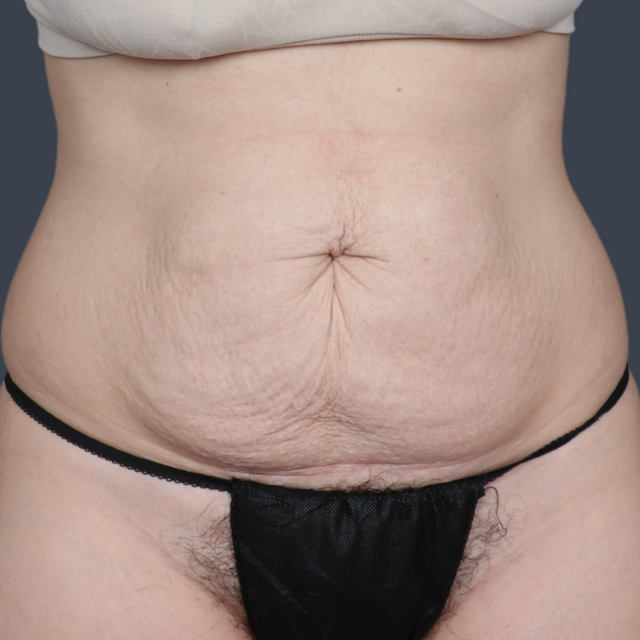 Tummy Tuck before at Dr. Christine Fisher MD, FACS in Austin, TX