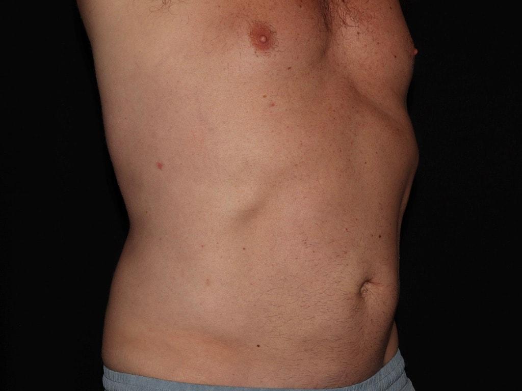 Alexander Cosmetic Surgery fat freezing after — San Diego, CA