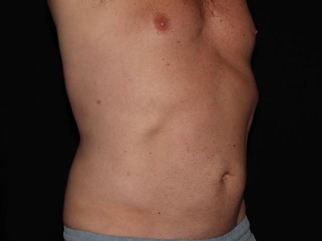 CoolSculpting after at Alexander Cosmetic Surgery in San Diego, CA