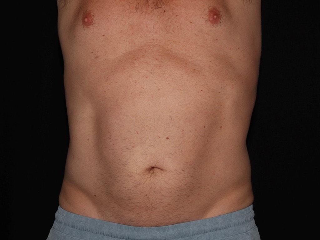 Alexander Cosmetic Surgery fat freezing after — San Diego, CA