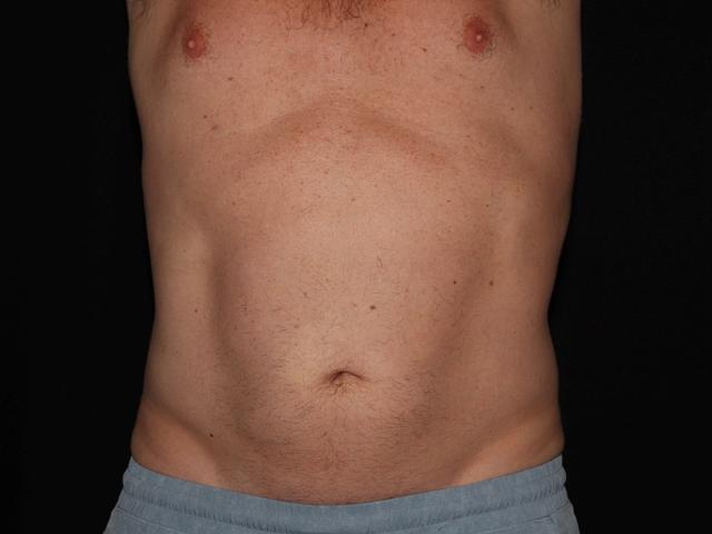 CoolSculpting after at Alexander Cosmetic Surgery in San Diego, CA