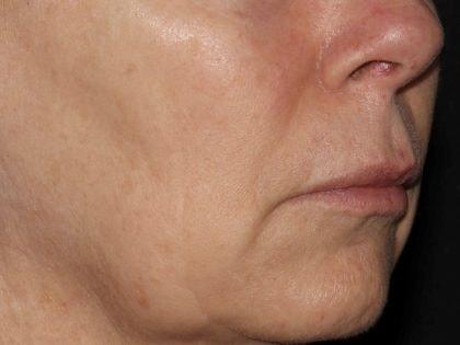 Lip Filler before at Alexander Cosmetic Surgery in San Diego, CA