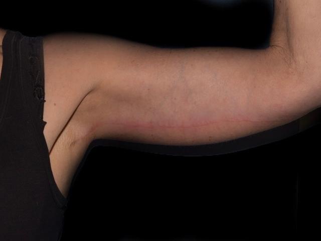 Arm Lift after at Alexander Cosmetic Surgery in San Diego, CA