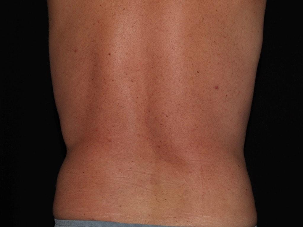 Alexander Cosmetic Surgery fat freezing after — San Diego, CA