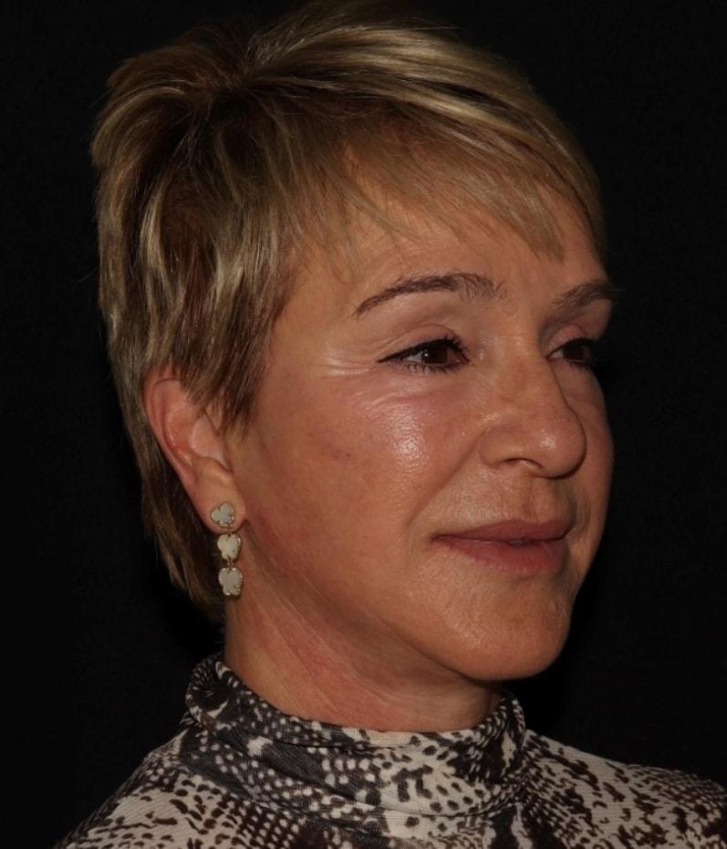 Alexander Cosmetic Surgery facelift after — San Diego, CA