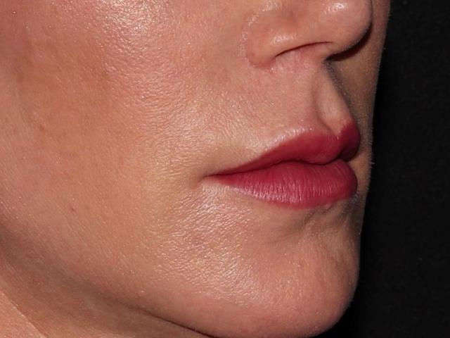 Lip Filler before at Alexander Cosmetic Surgery in San Diego, CA