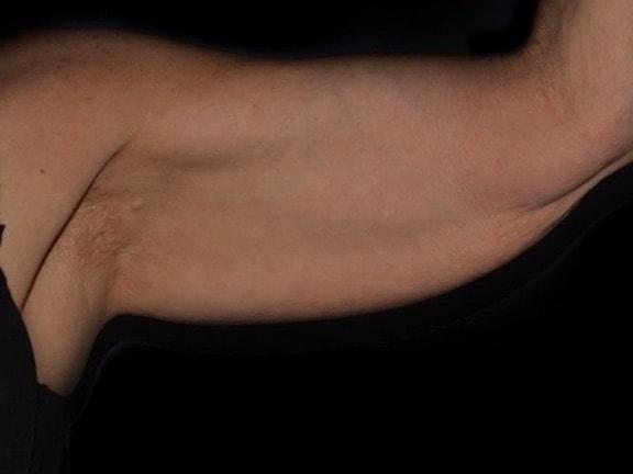 Arm Lift before at Alexander Cosmetic Surgery in San Diego, CA