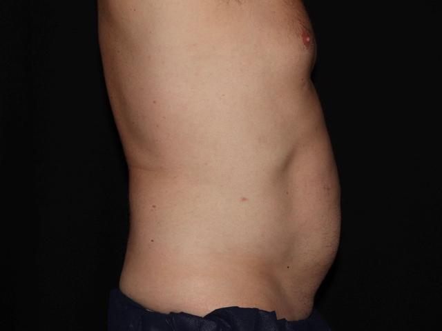 CoolSculpting before at Alexander Cosmetic Surgery in San Diego, CA
