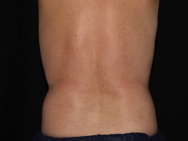 CoolSculpting before at Alexander Cosmetic Surgery in San Diego, CA