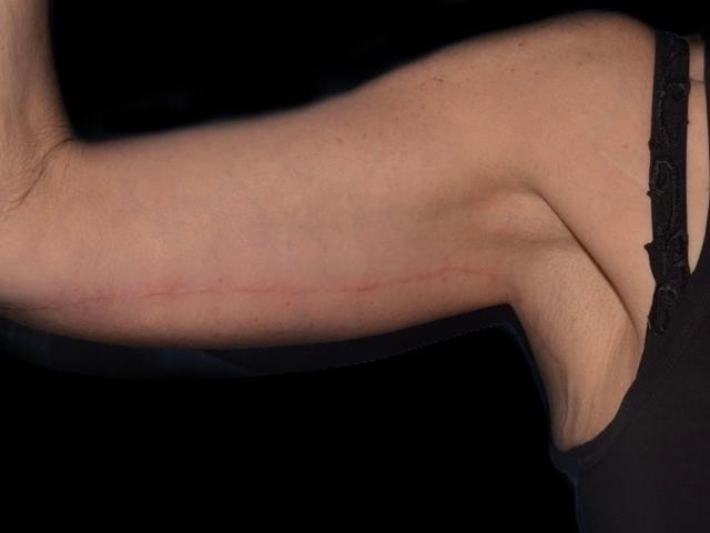 Arm Lift after at Alexander Cosmetic Surgery in San Diego, CA