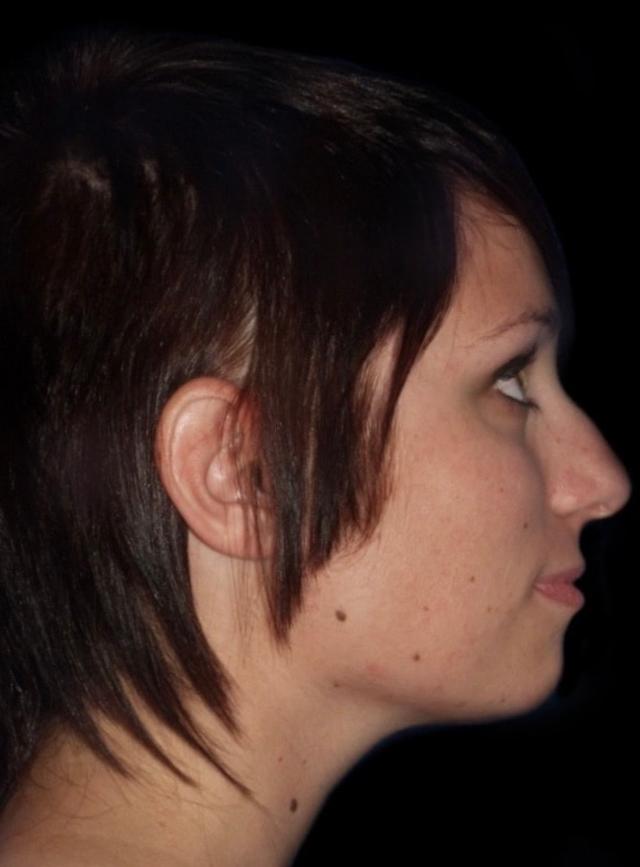 Functional Rhinoplasty before at Alexander Cosmetic Surgery in San Diego, CA