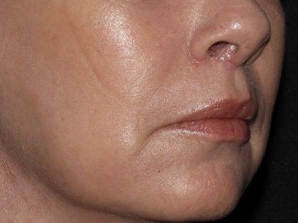 Lip Filler after at Alexander Cosmetic Surgery in San Diego, CA