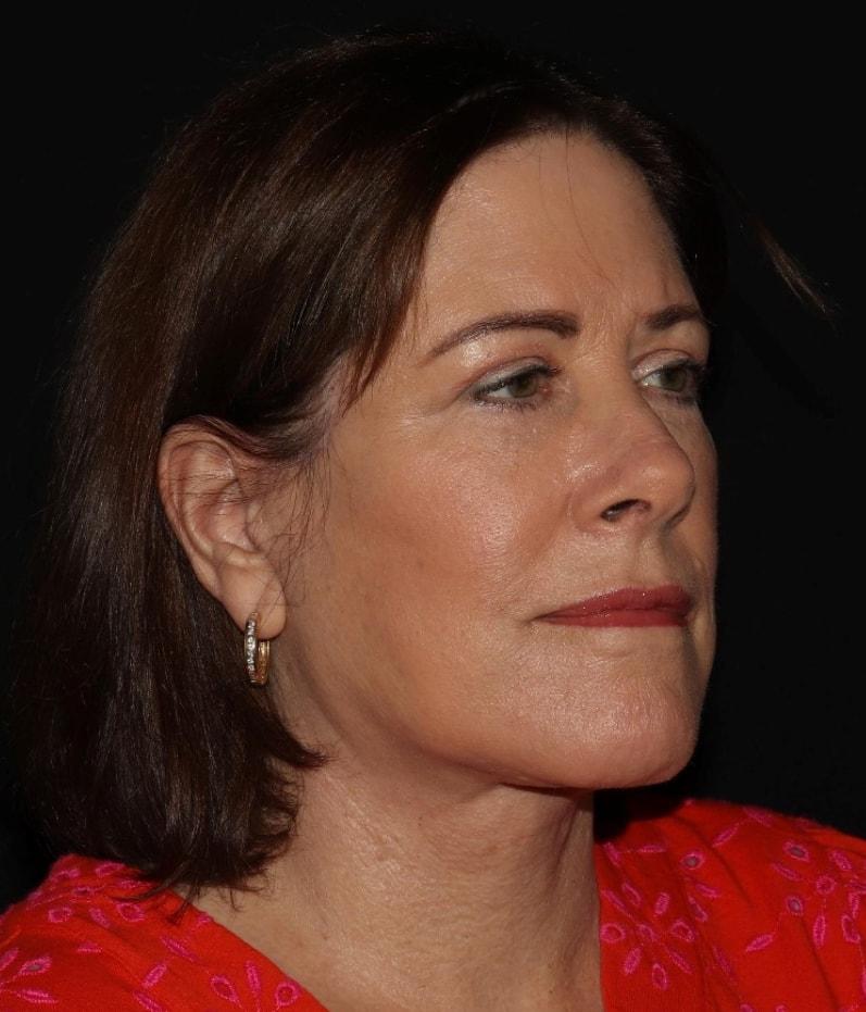 Alexander Cosmetic Surgery facelift after — San Diego, CA