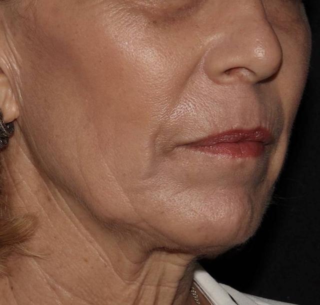 Laser Skin Resurfacing after at Alexander Cosmetic Surgery in San Diego, CA