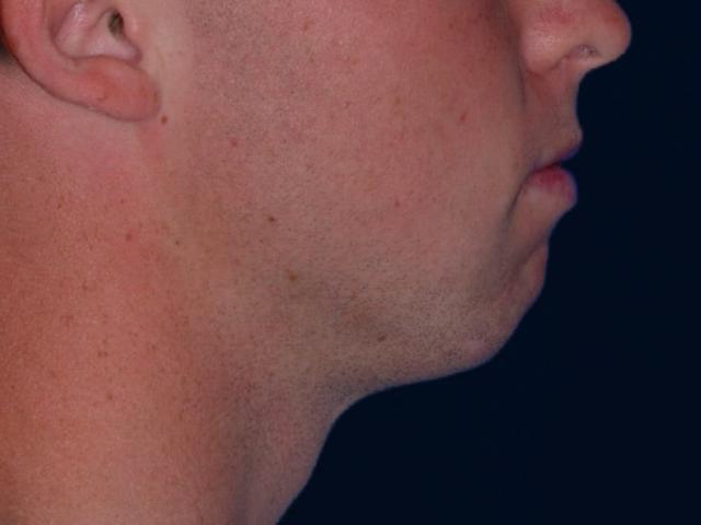 Chin Implant before at Alexander Cosmetic Surgery in San Diego, CA