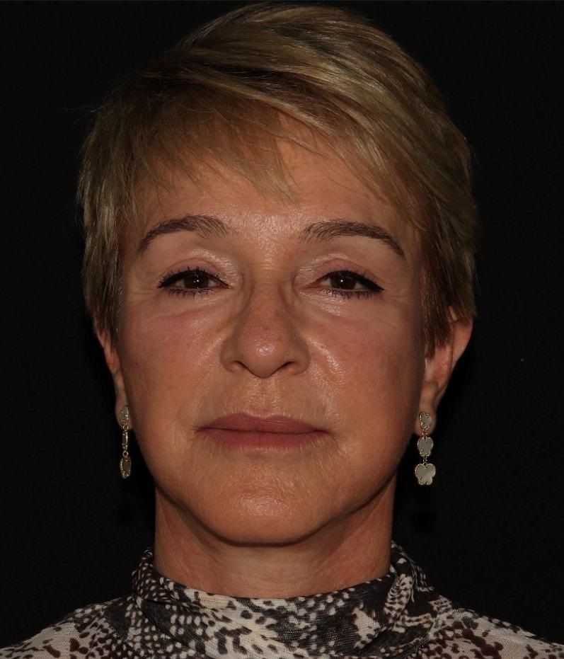 Alexander Cosmetic Surgery facelift after — San Diego, CA