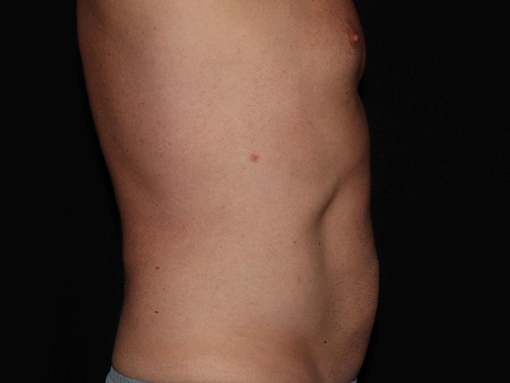 Alexander Cosmetic Surgery fat freezing after — San Diego, CA