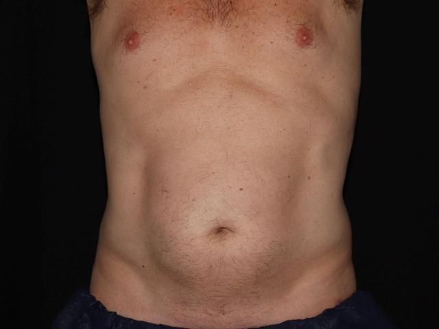 CoolSculpting before at Alexander Cosmetic Surgery in San Diego, CA