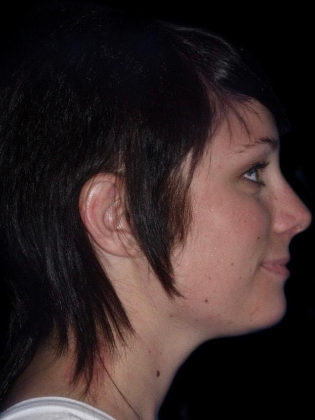Functional Rhinoplasty after at Alexander Cosmetic Surgery in San Diego, CA