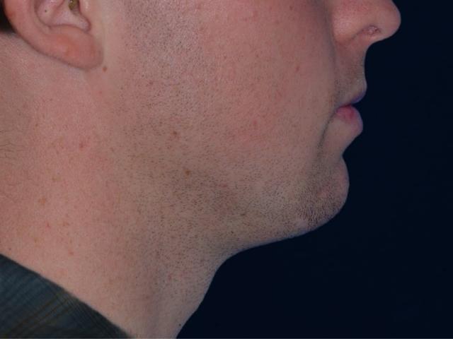 Chin Implant after at Alexander Cosmetic Surgery in San Diego, CA