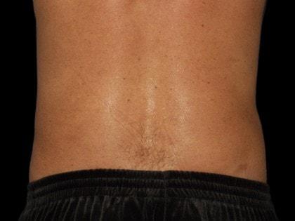 Liposuction after at Alexander Cosmetic Surgery in San Diego, CA