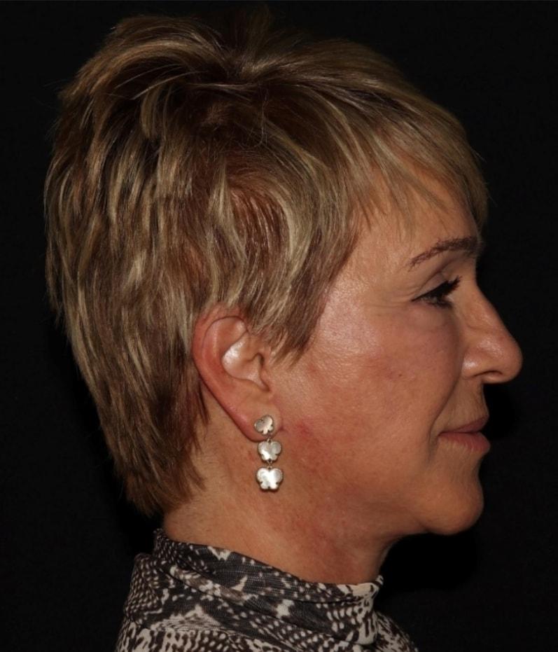 Alexander Cosmetic Surgery facelift after — San Diego, CA