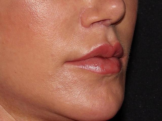 Lip Filler after at Alexander Cosmetic Surgery in San Diego, CA