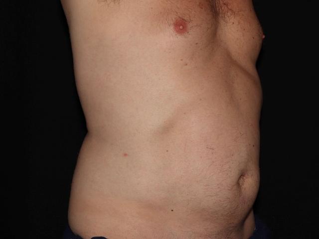 CoolSculpting before at Alexander Cosmetic Surgery in San Diego, CA