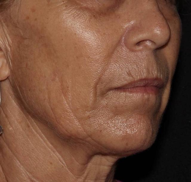 Laser Skin Resurfacing before at Alexander Cosmetic Surgery in San Diego, CA
