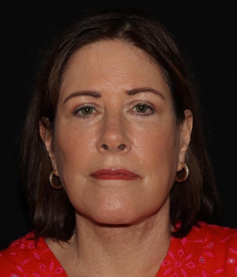 Alexander Cosmetic Surgery facelift after — San Diego, CA