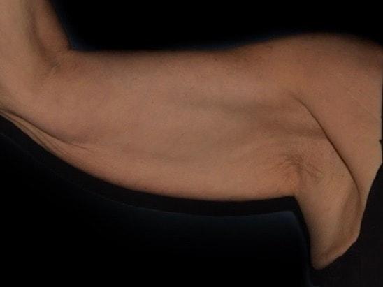 Arm Lift before at Alexander Cosmetic Surgery in San Diego, CA