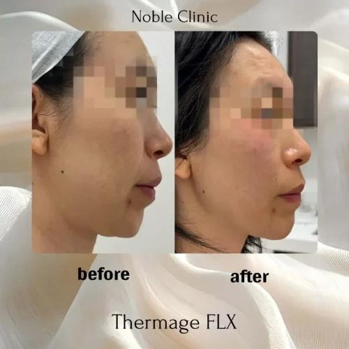 Noble Clinic skin tightening result — Draper, UT
