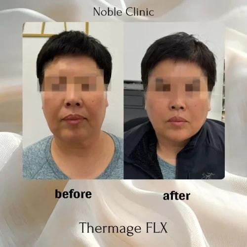 Noble Clinic skin tightening result — Draper, UT