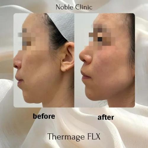 Noble Clinic skin tightening result — Draper, UT